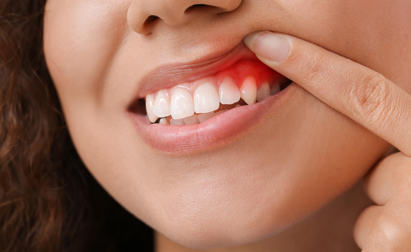 Gum Disease Brandon, MS