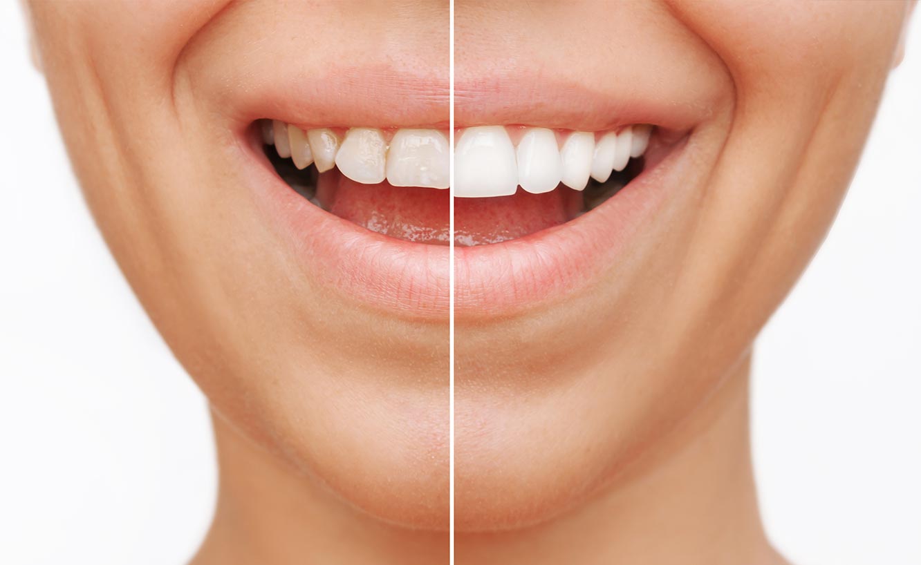 Before and After' Teeth Repair Results