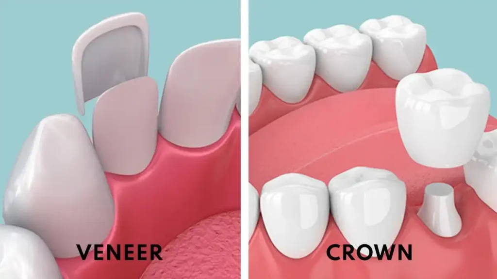 Mississippi Crowns vs Veneers